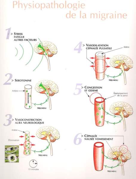 cephalees identifier